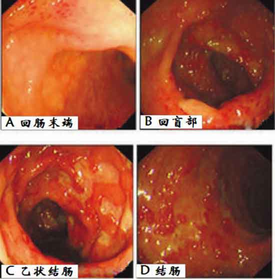 为胃息肉,胃糜烂;回盲部(小肠与盲肠交接处)和结肠内均有较严重溃疡